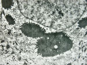 F, 11y. | ichthyosis hystrix type Curth-Macklin